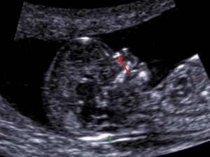 prvotrimestralni-screening-img