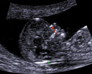 prvotrimestralni-screening-02