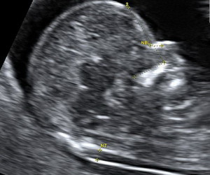 prvotrimestralni-screening-01